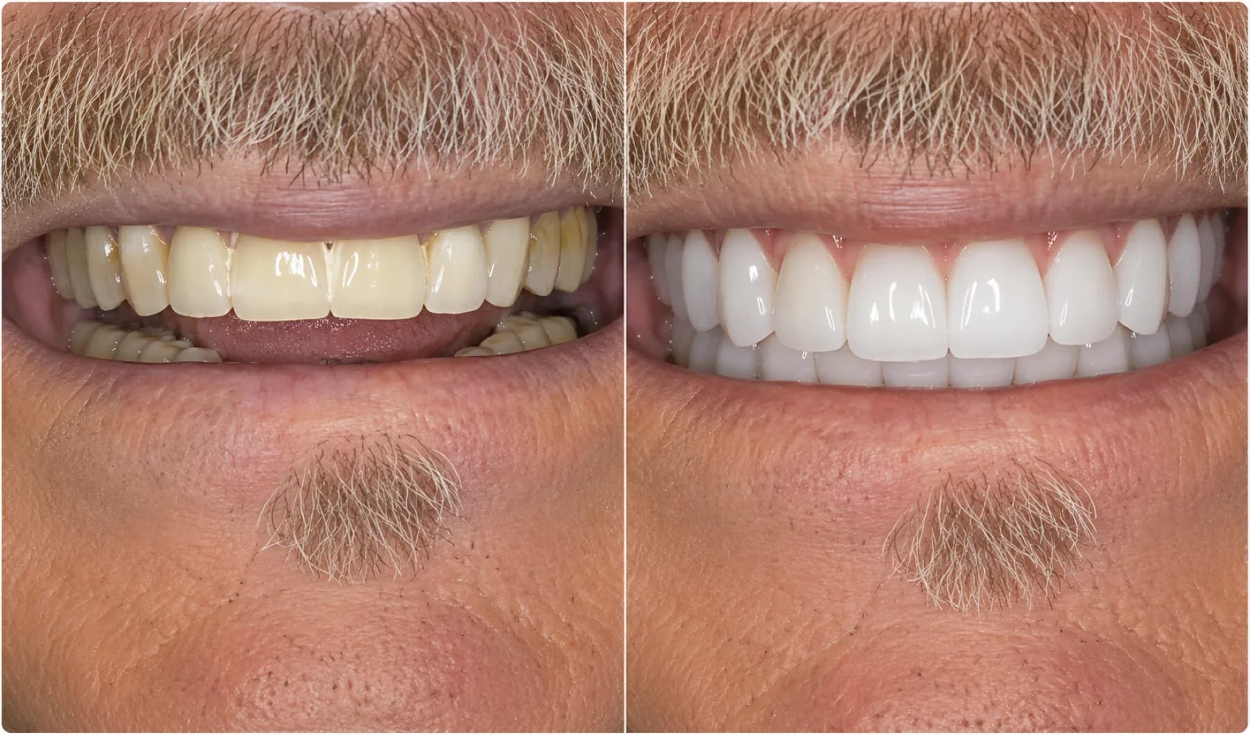 Dentures Before and After